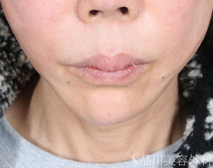 症例NO.72361のAFTER写真