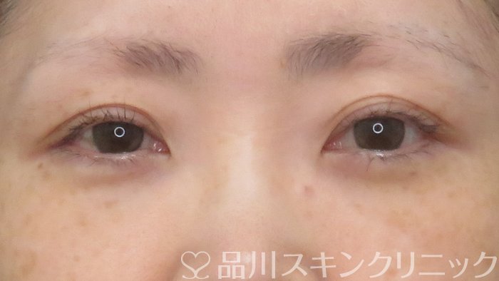 症例NO.68999のAFTER写真