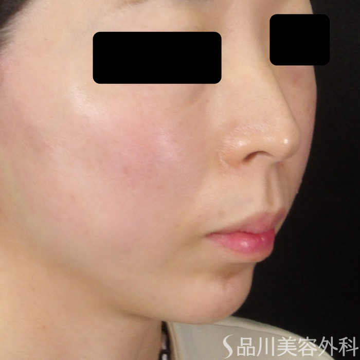 症例NO.71500のAFTER写真
