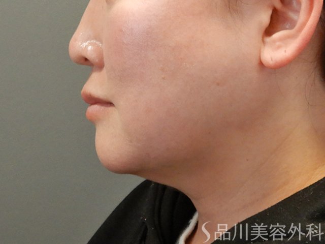 症例NO.75064のBEFORE写真