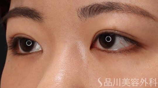 症例NO.69676のAFTER写真