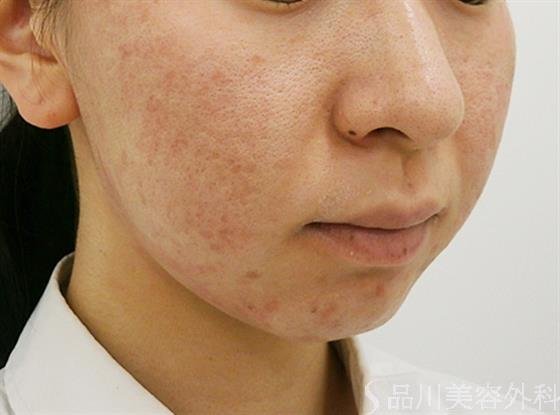 症例NO.40748のBEFORE写真