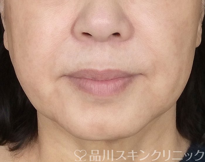 症例NO.68438のBEFORE写真