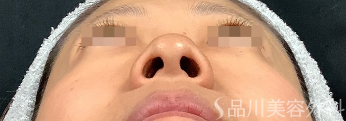 症例NO.67914のBEFORE写真