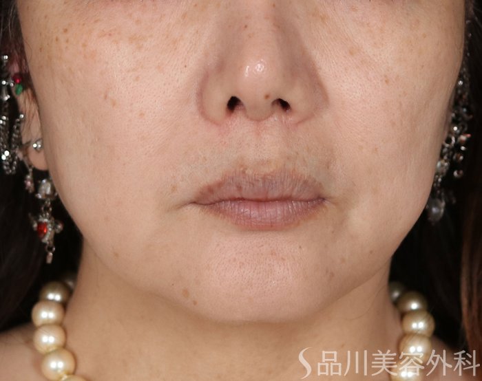 症例NO.72255のBEFORE写真