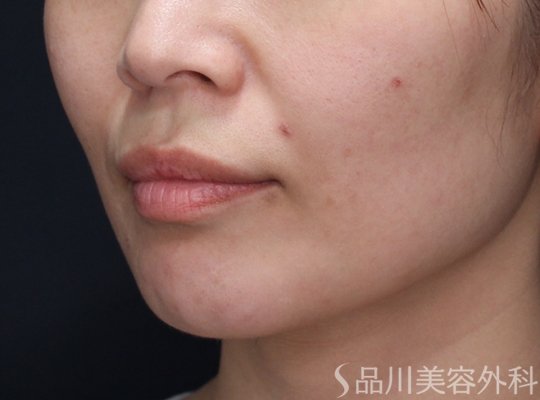 症例NO.73914のBEFORE写真