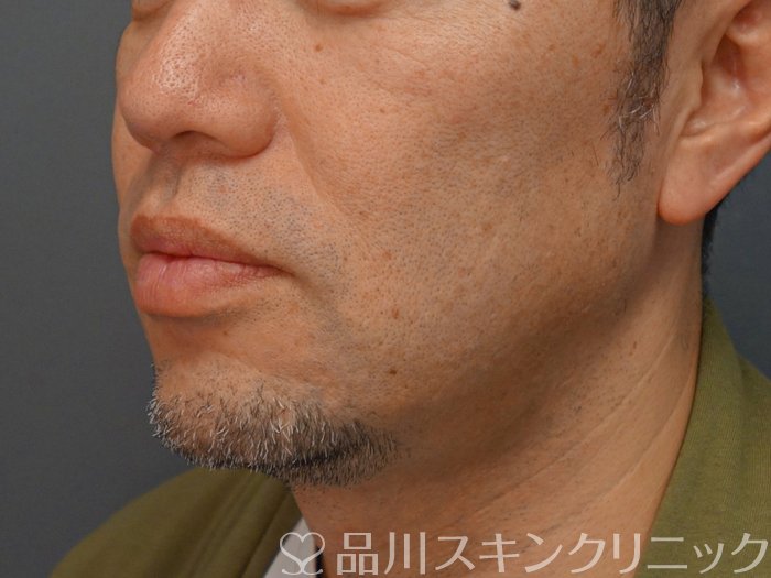 症例NO.74257のBEFORE写真