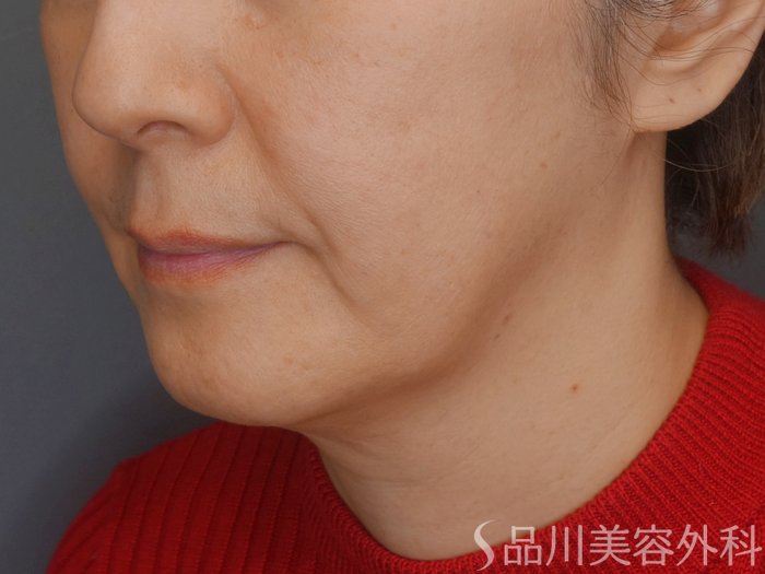 症例NO.72338のBEFORE写真