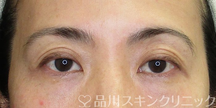 症例NO.74427のBEFORE写真