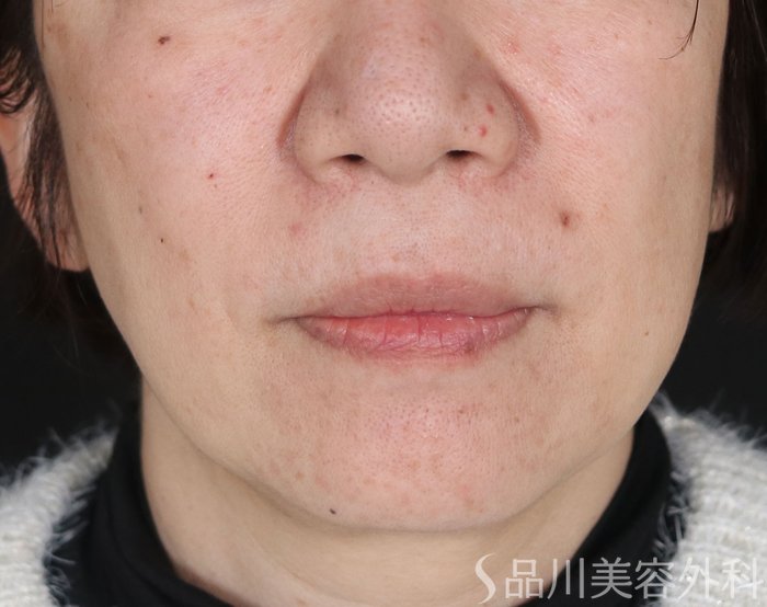 症例NO.72575のBEFORE写真