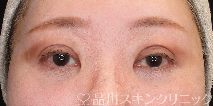症例NO.74361のAFTER写真