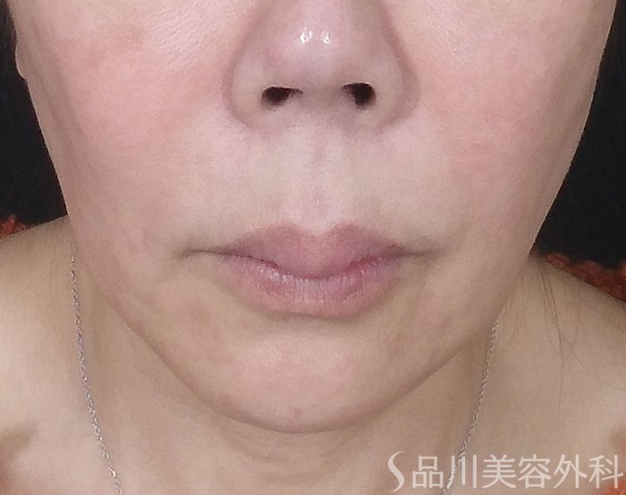 症例NO.69891のBEFORE写真