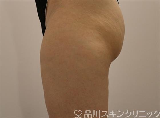症例NO.42716のBEFORE写真