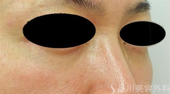 症例NO.46383のAFTER写真