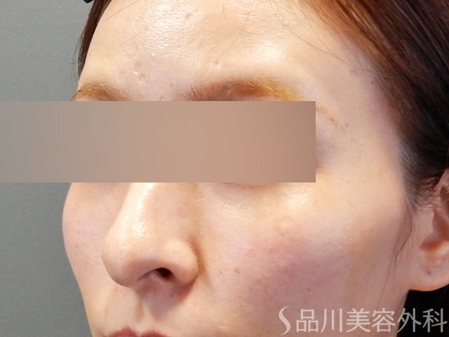 症例NO.67974のAFTER写真