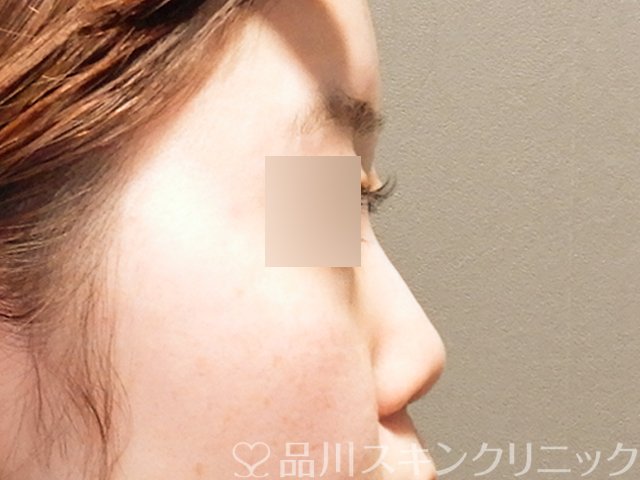 症例NO.69297のBEFORE写真