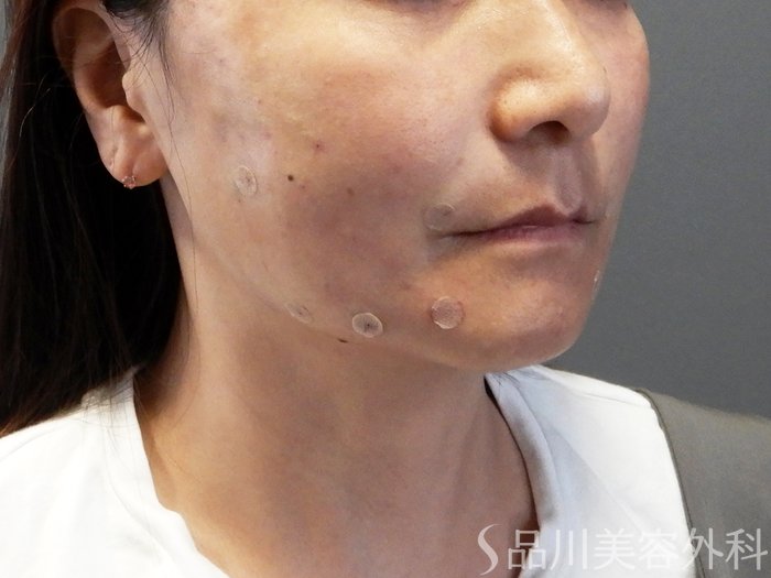 症例NO.65187のAFTER写真
