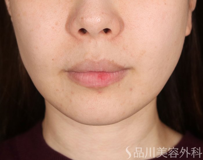 症例NO.73261のBEFORE写真