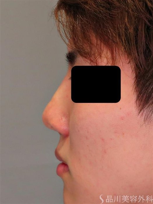 症例NO.49307のAFTER写真