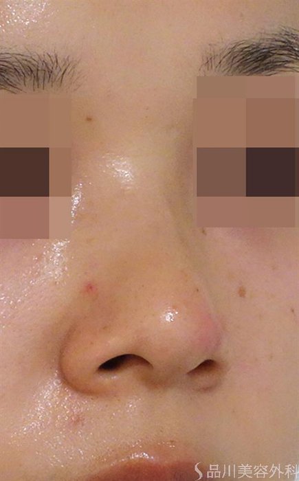 症例NO.40180のBEFORE写真