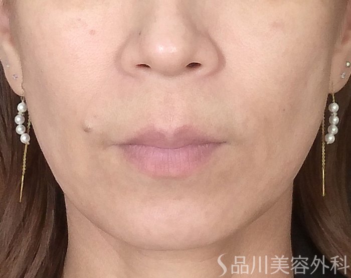 症例NO.70143のBEFORE写真