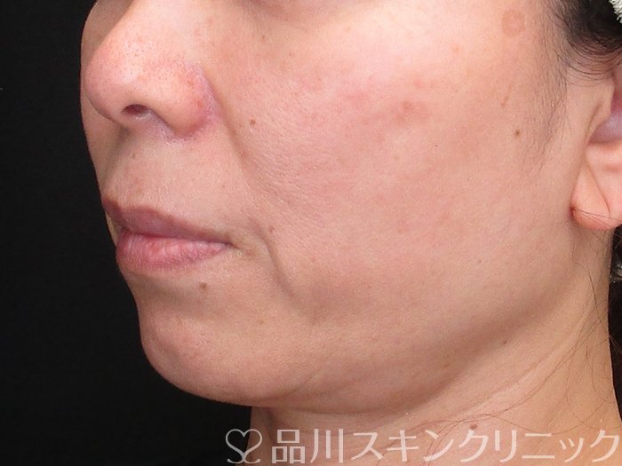 症例NO.72922のBEFORE写真