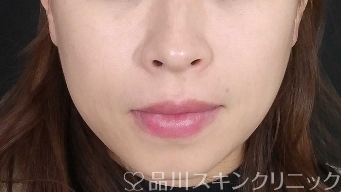 症例NO.72062のAFTER写真