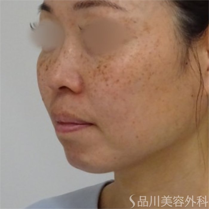 症例NO.70438のBEFORE写真