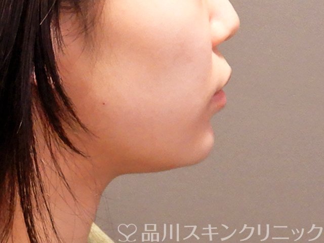 症例NO.69914のAFTER写真