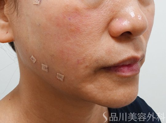 症例NO.73051のAFTER写真