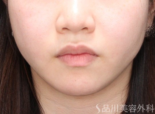 症例NO.69971のAFTER写真