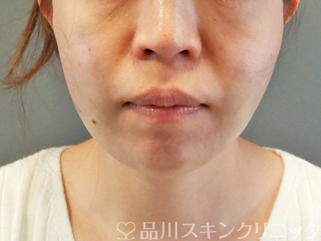 症例NO.63175のAFTER写真