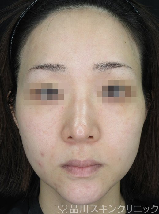 症例NO.69991のBEFORE写真