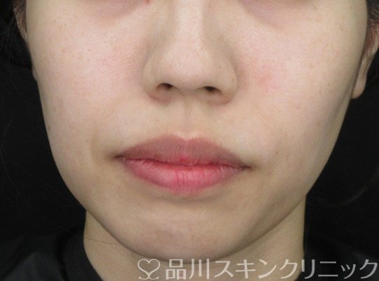 症例NO.68734のBEFORE写真