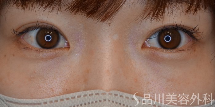 症例NO.70422のBEFORE写真