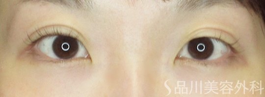 症例NO.70997のAFTER写真
