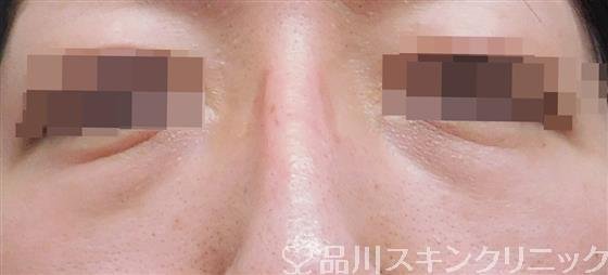 症例NO.61684のBEFORE写真