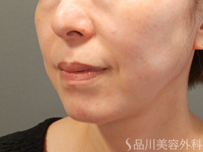 症例NO.72002のAFTER写真