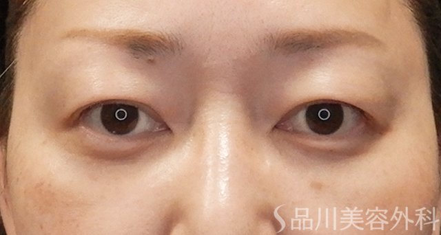 症例NO.74956のAFTER写真