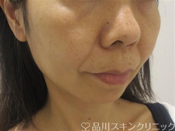 症例NO.38242のBEFORE写真