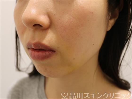 症例NO.44662のAFTER写真