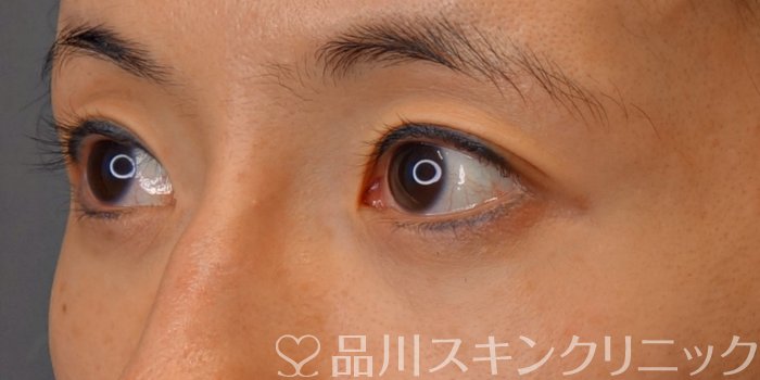 症例NO.75253のBEFORE写真