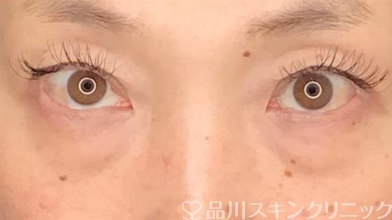 症例NO.61101のBEFORE写真