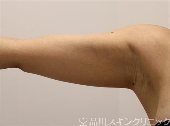 症例NO.45740のBEFORE写真
