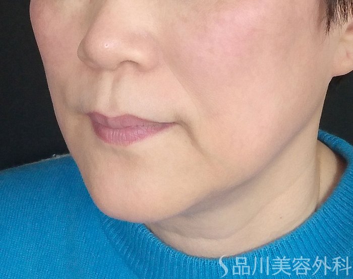 症例NO.69342のBEFORE写真