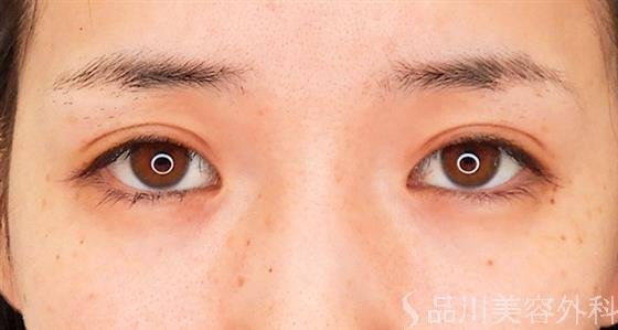症例NO.60738のAFTER写真