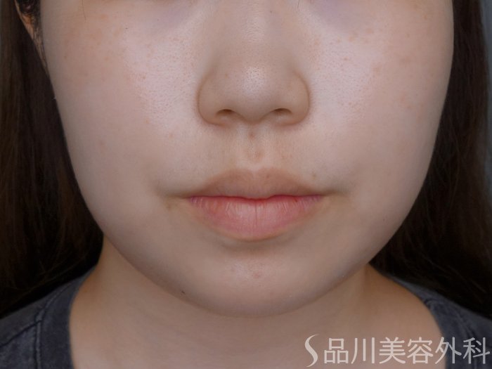症例NO.73909のBEFORE写真