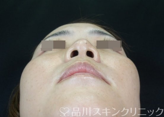 症例NO.72600のBEFORE写真