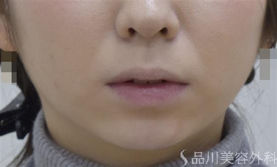 症例NO.46845のAFTER写真