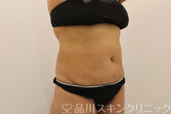 症例NO.74003のBEFORE写真